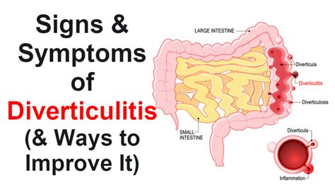 Diverticulosis: What It Is, Symptoms, Causes & Treatment